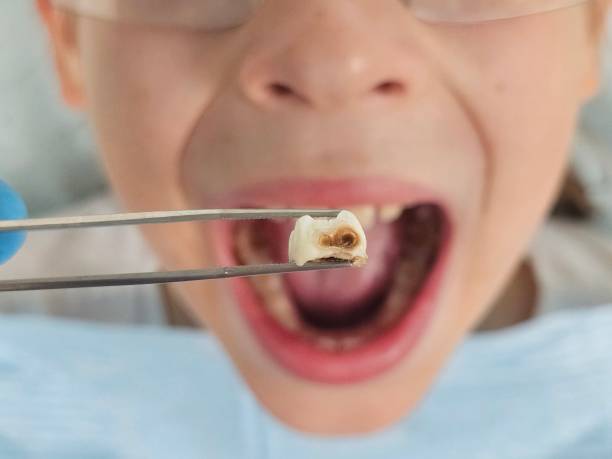 Best Emergency Dental Extractions in Buckhannon, WV